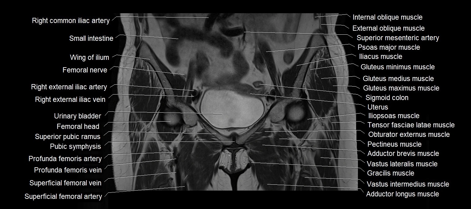 MRI 3T pelvis coronal cross section anatomy image 9.webp